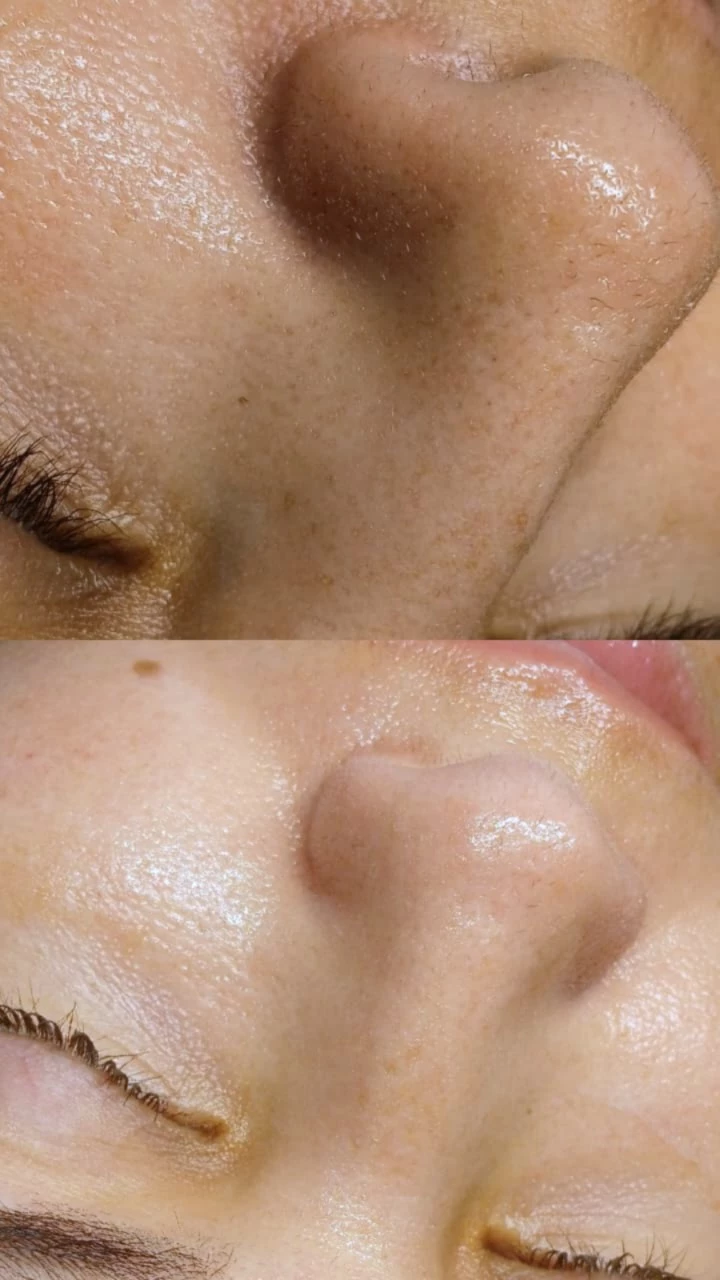 Limpieza facial profunda